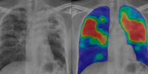 Far from Bangui, AI helps screen for tuberculosis